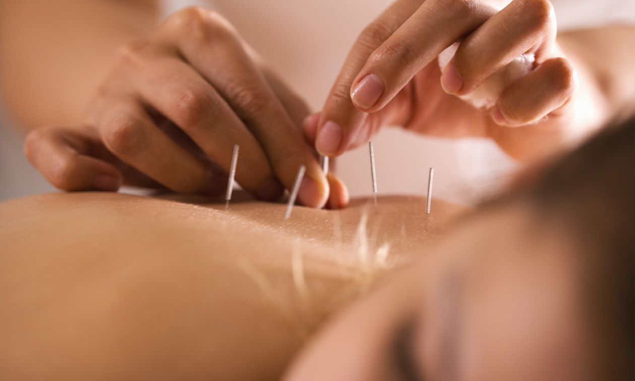 Acupunctuurbehandeling (60 min)