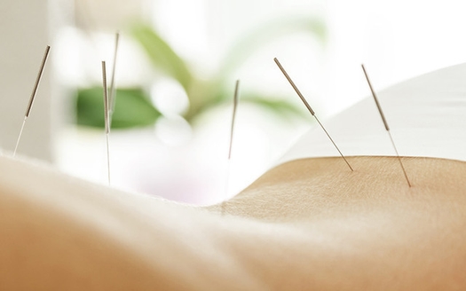 Afslappende akupunktur og cupping