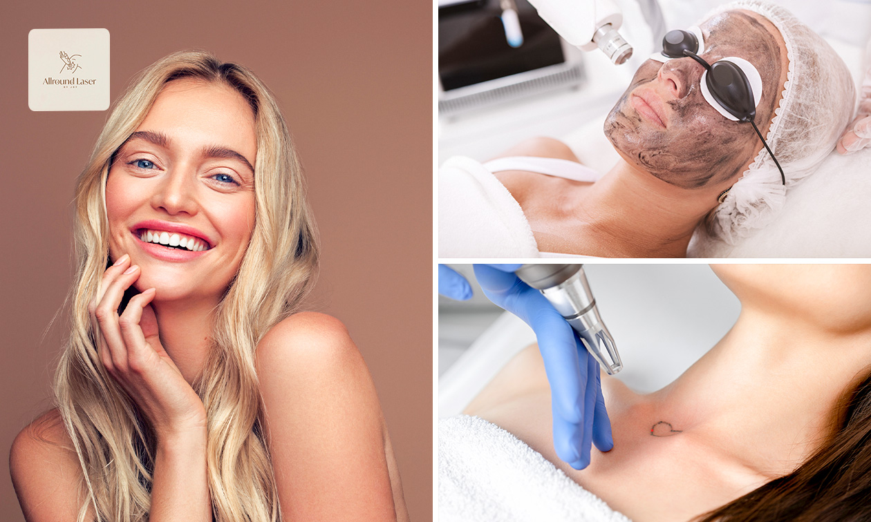 Carbon peeling of tatoeage verwijderen