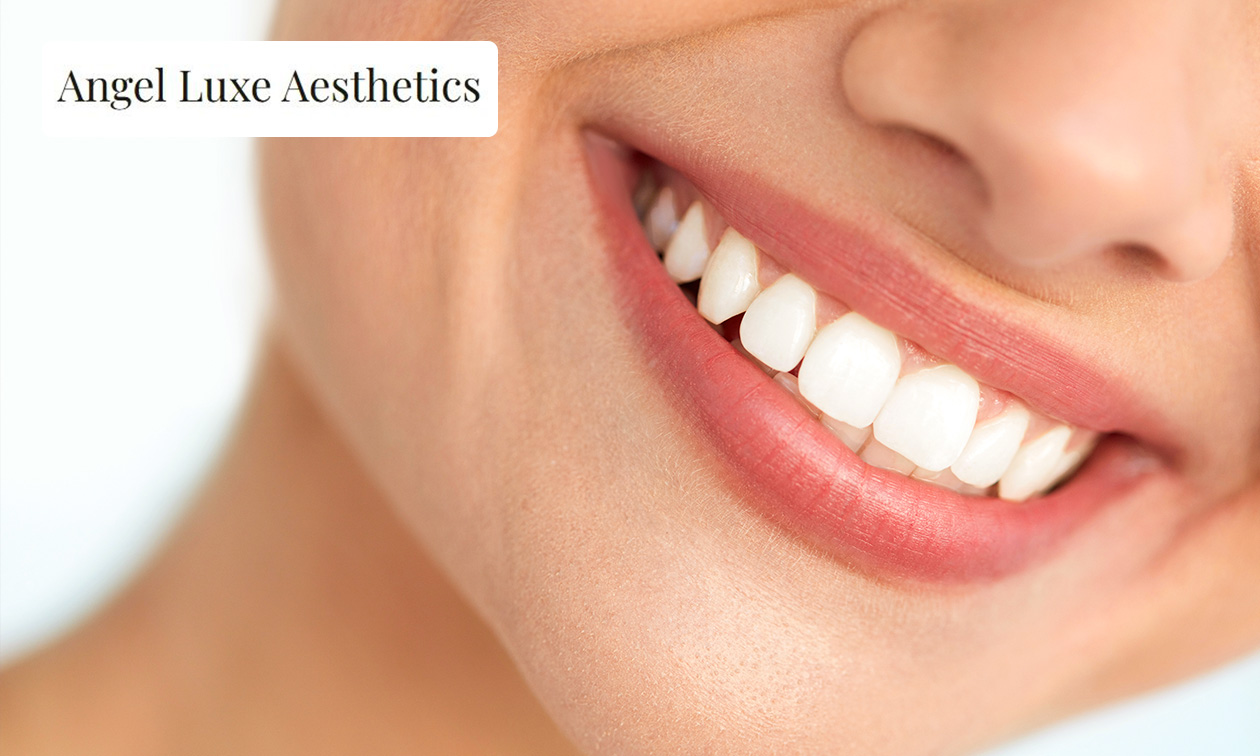 Tandenbleekbehandeling (20 of 40 min)