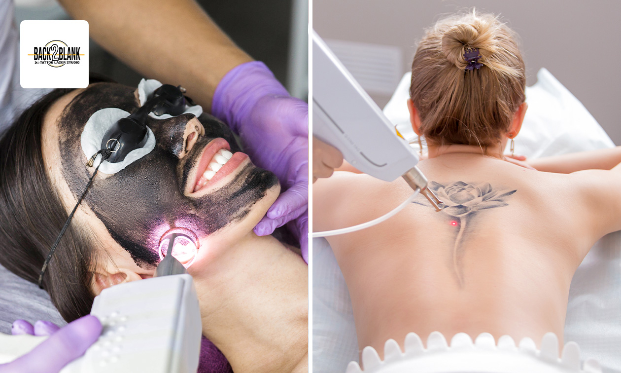 Carbon peeling voor een zone naar keuze of tatoeage verwijderen (tot 35 cm)