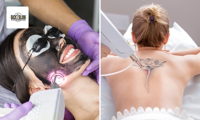 Carbon peeling voor een zone naar keuze of tatoeage verwijderen (tot 35 cm)