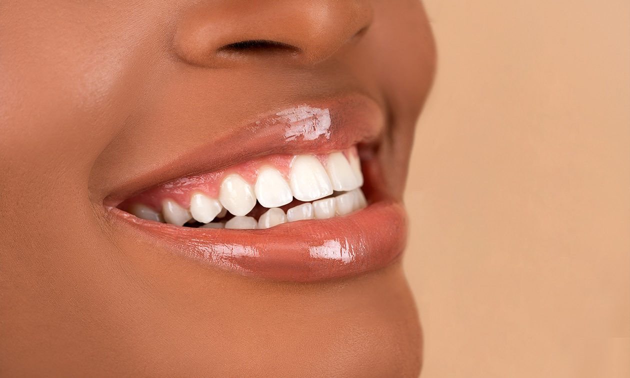 Tanden bleken (3 of 5 x 20 min)