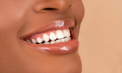 Tanden bleken (3 of 5 x 20 min)