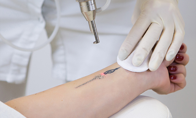 Verwijder je tattoo, permanente make-up of pigmentvlek