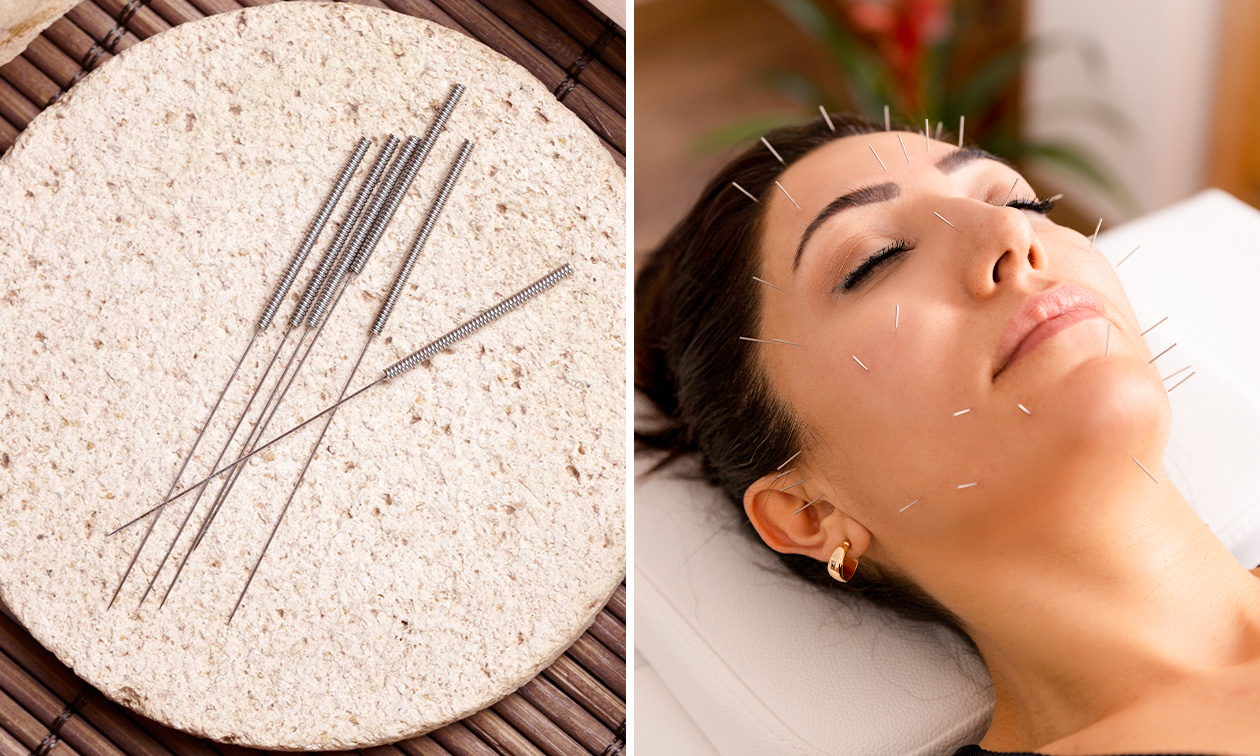 Beauty balance-acupunctuurbehandeling naar keuze (50 of 100 min)