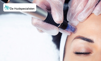 1, 4 of 6 basis of luxe microneedling-behandeling(en)