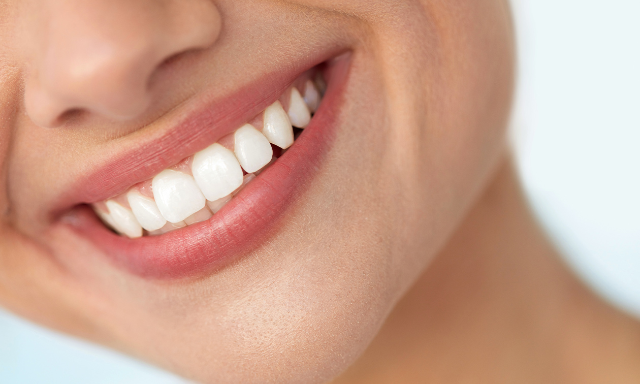 Tandenbleekbehandeling (3 of 5x 20 min)