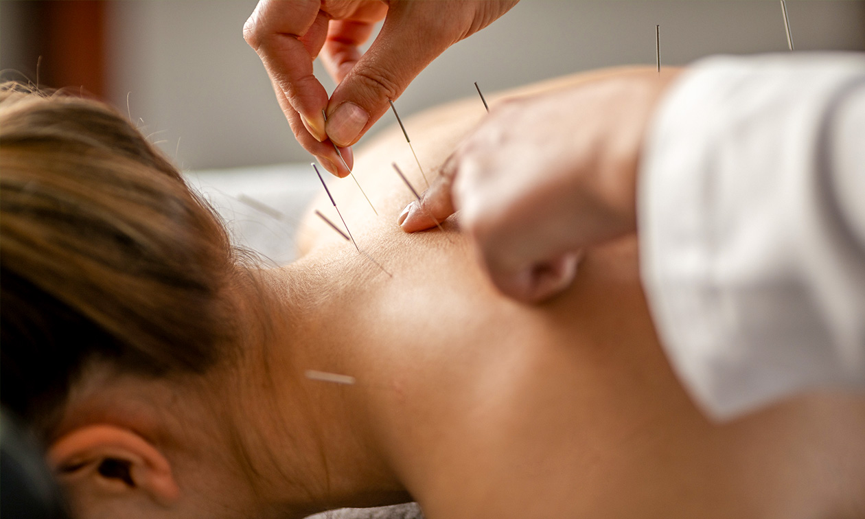 Acupunctuurbehandeling + intake (60 min)