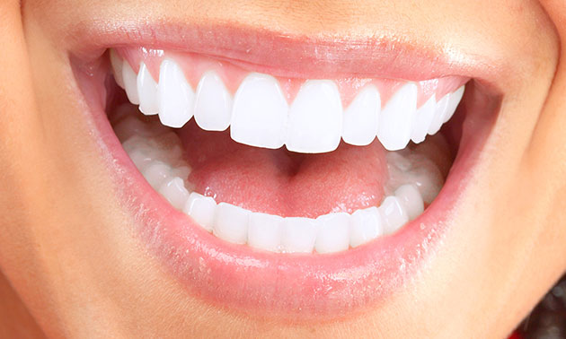 Tanden whitening voor 1 of 2 personen
