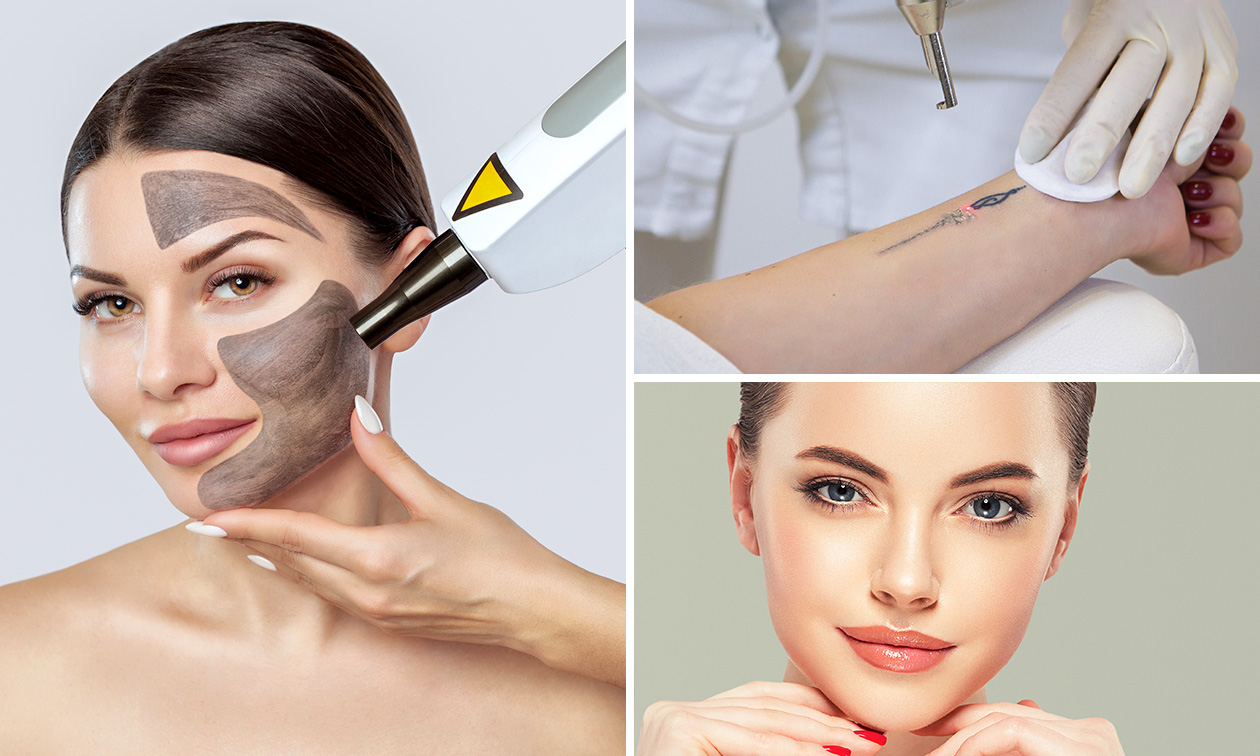 Carbon laser peeling, PMU verwijderen of tattoo verwijderen