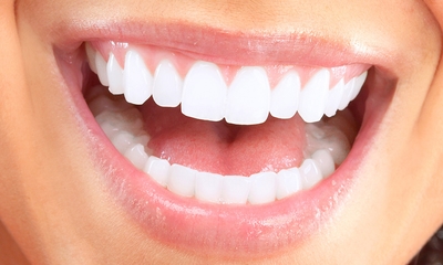 3 oder 6 Zahnbleaching-Behandlungen (à 20 Minuten)