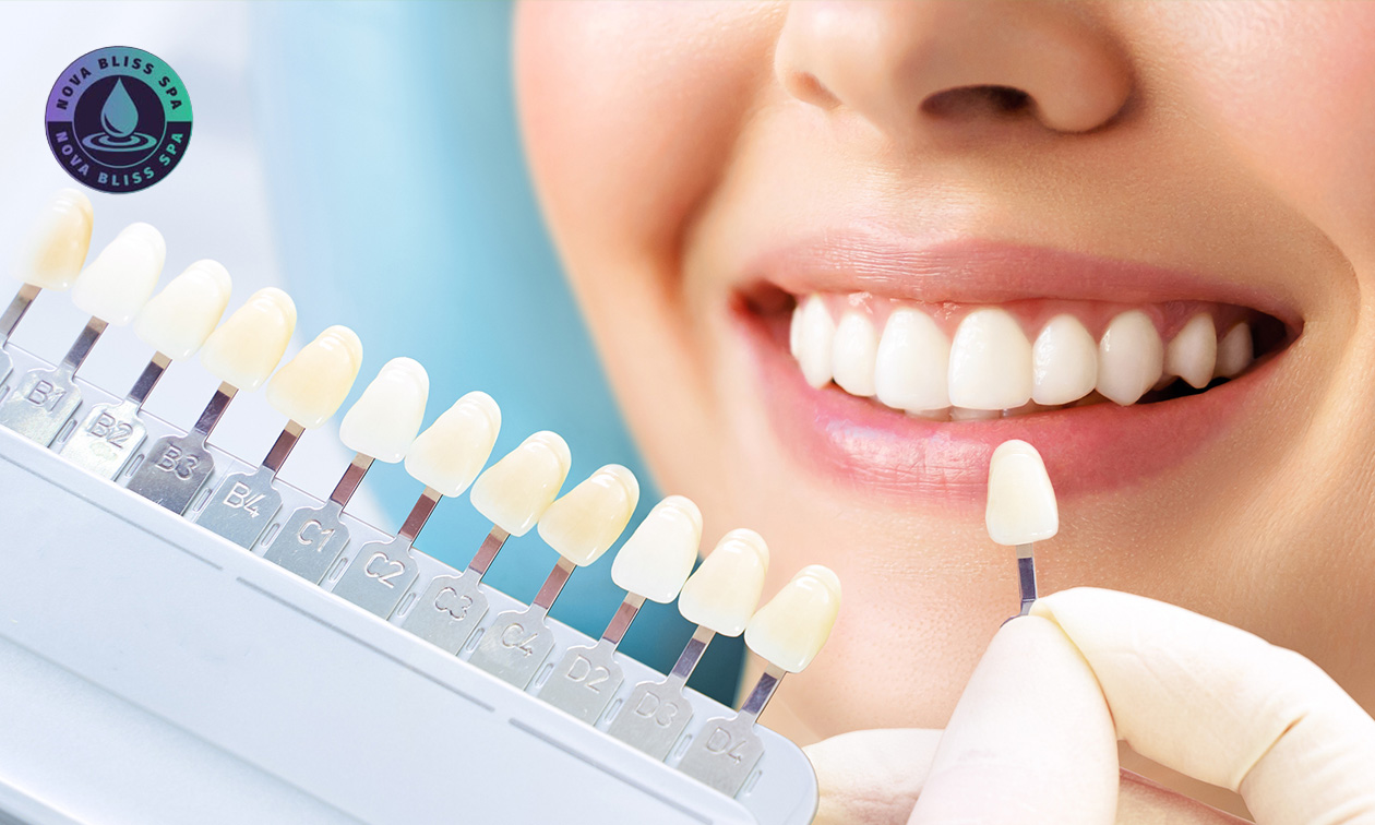 Tandenbleekbehandeling(en) (20 min)