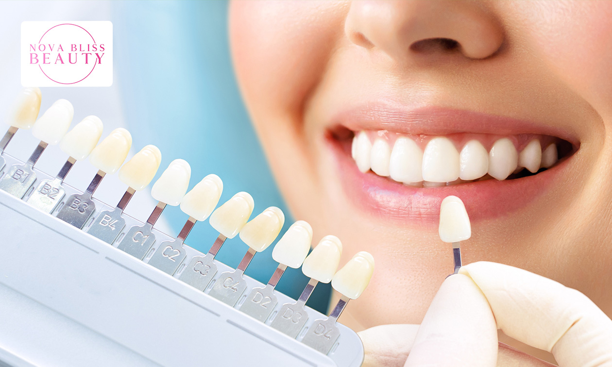 Tandenbleekbehandeling(en) (20 min)