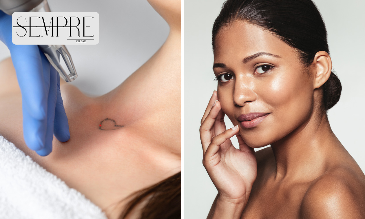 Chemische peeling of tattoo verwijderen