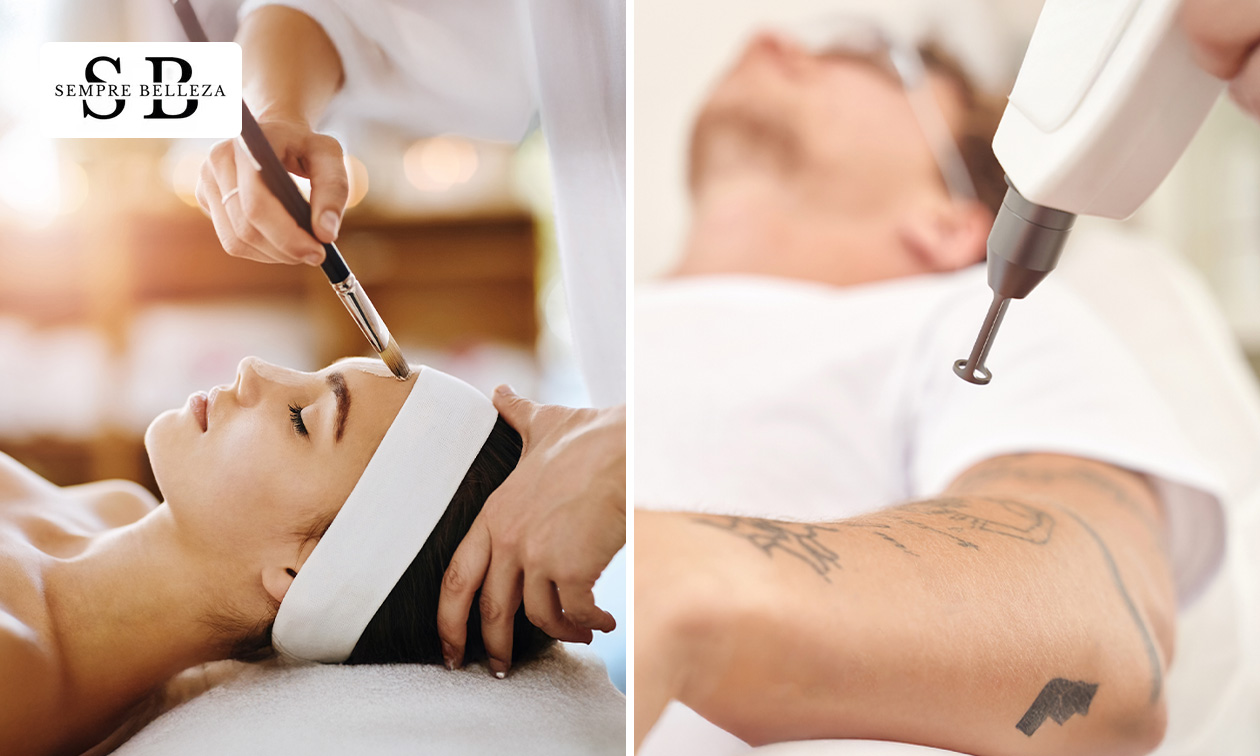 Chemische peeling of tatoeage verwijderen