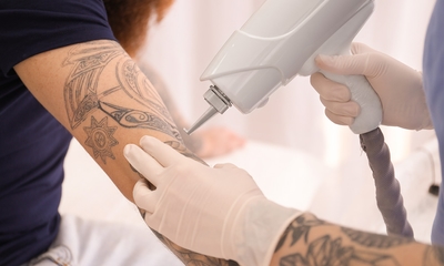 Permanente make-up of tattoo verwijderen