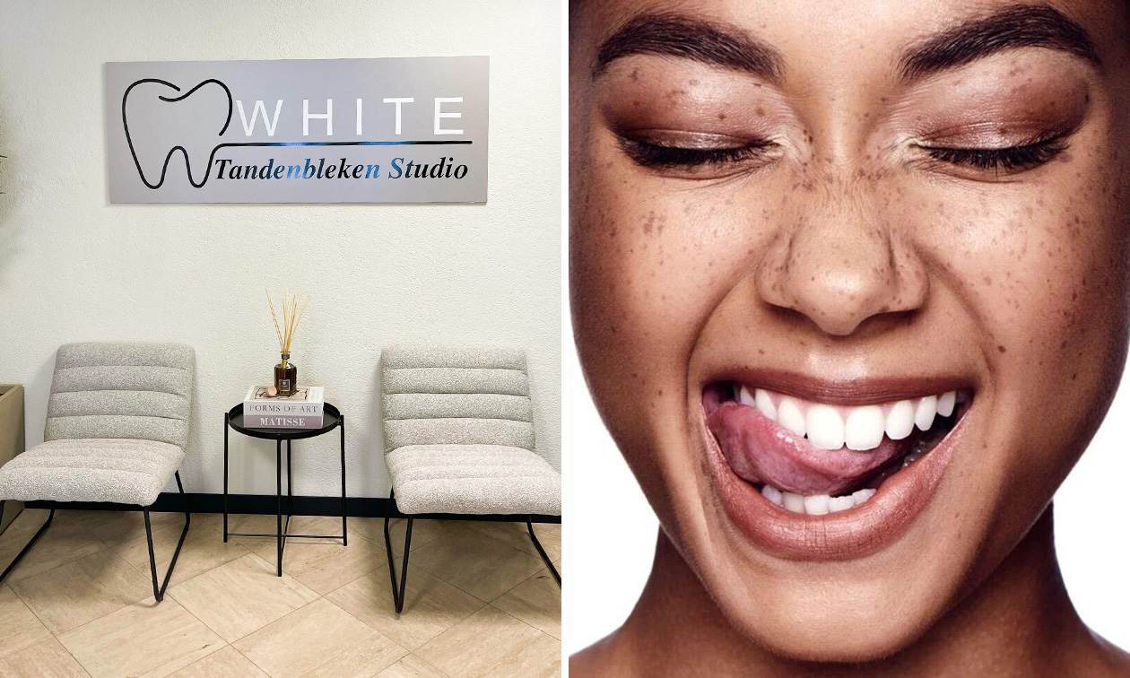 Tandenbleekbehandeling naar keuze