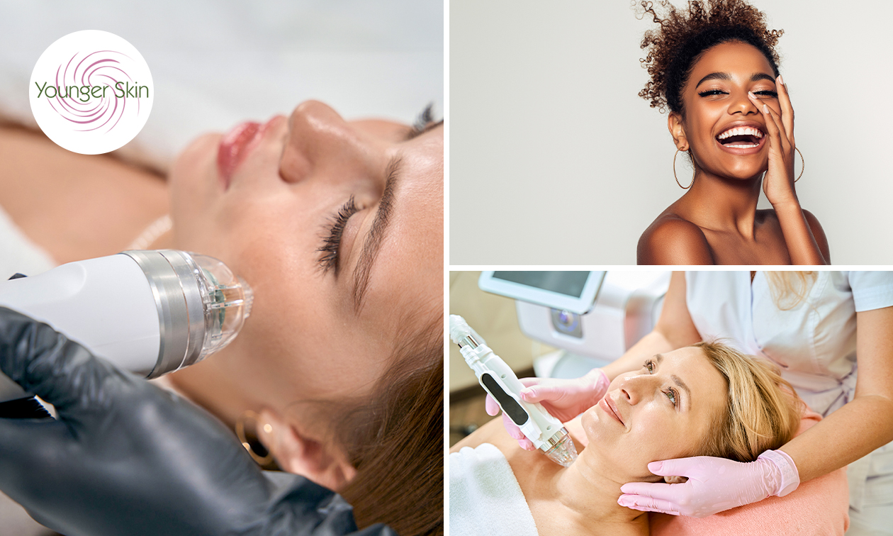 HIFU 8D-liftbehandeling of RF-microneedling voor zone naar keuze